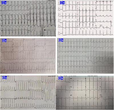 Case Report: Ventricular preexcitation-induced dilated cardiomyopathy improved by the pharmacologic suppression of ventricular preexcitation in three infants, and literature review